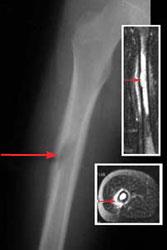 Tumor óseo del fémur (hueso del muslo)