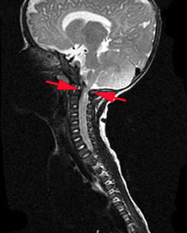X-ray of spinal cord compression