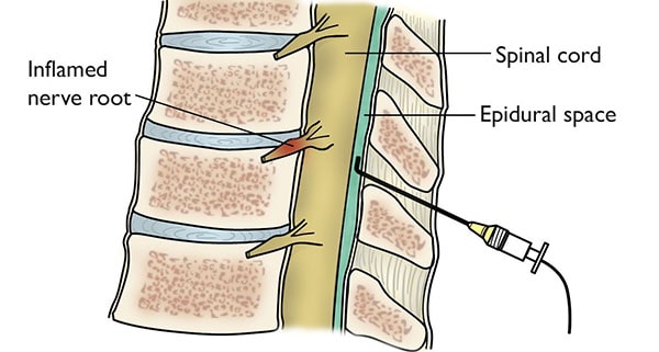 Lumbar and Cervical Spondylosis: Symptoms & Treatments