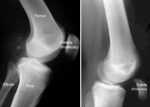 Quadriceps Tendon Tear - OrthoInfo - AAOS