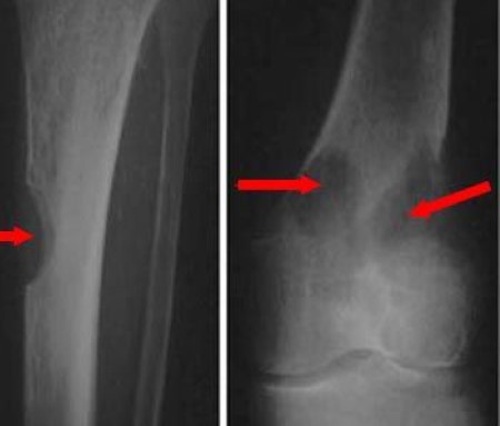 X-rays of multiple myeloma in leg