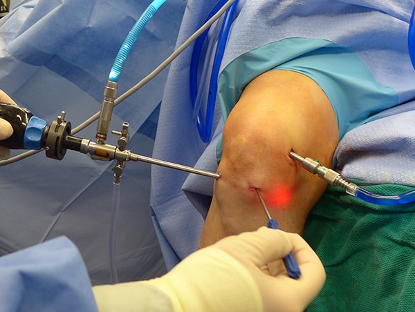 knee arthroscopy