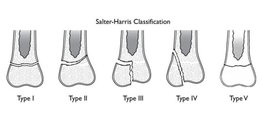 growth-plate-fractures-orthoinfo-aaos