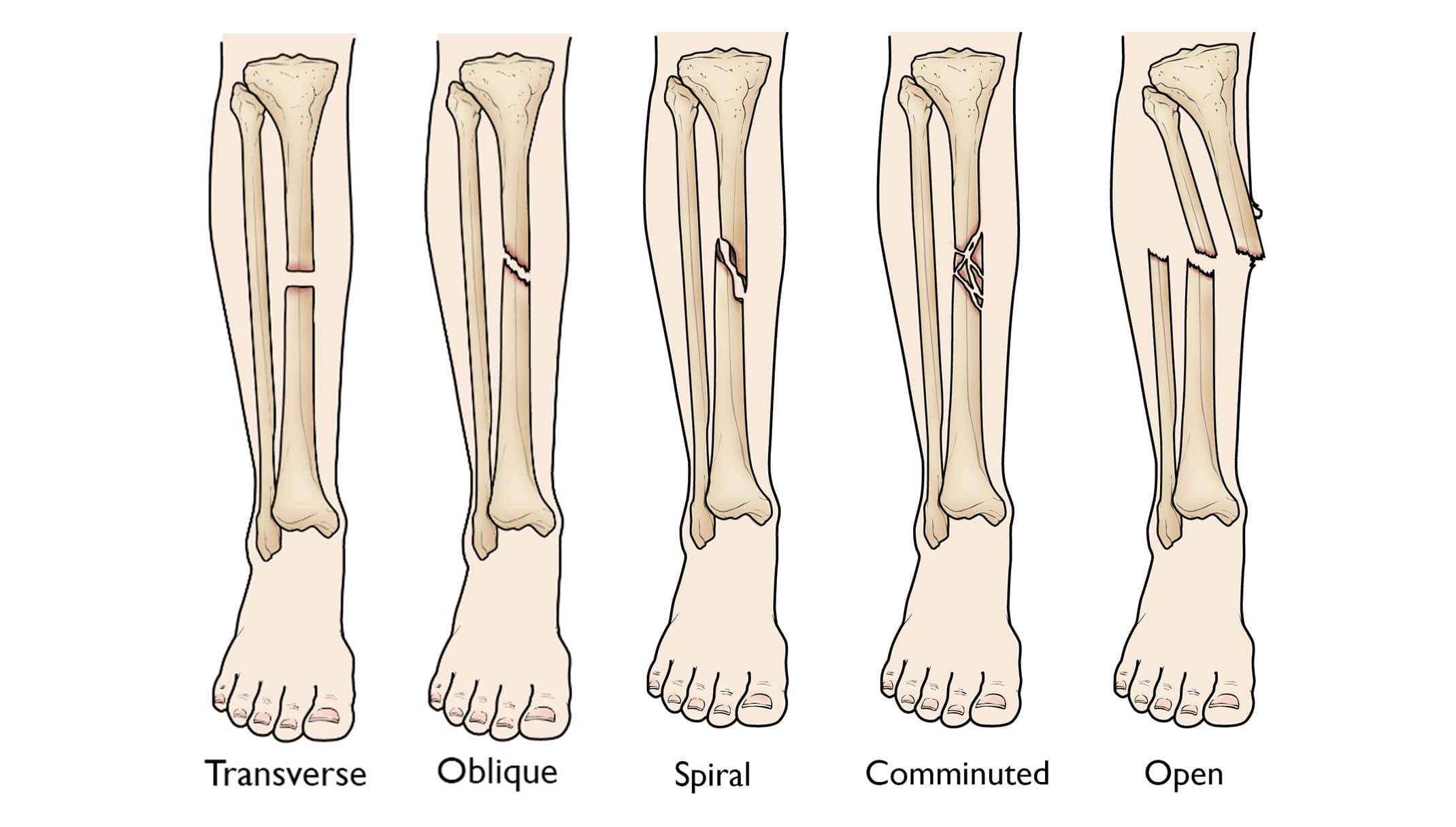 Types of fractures