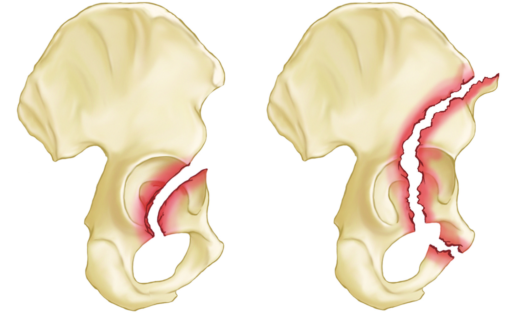 Anterior wall and anterior column acetabulum fractures