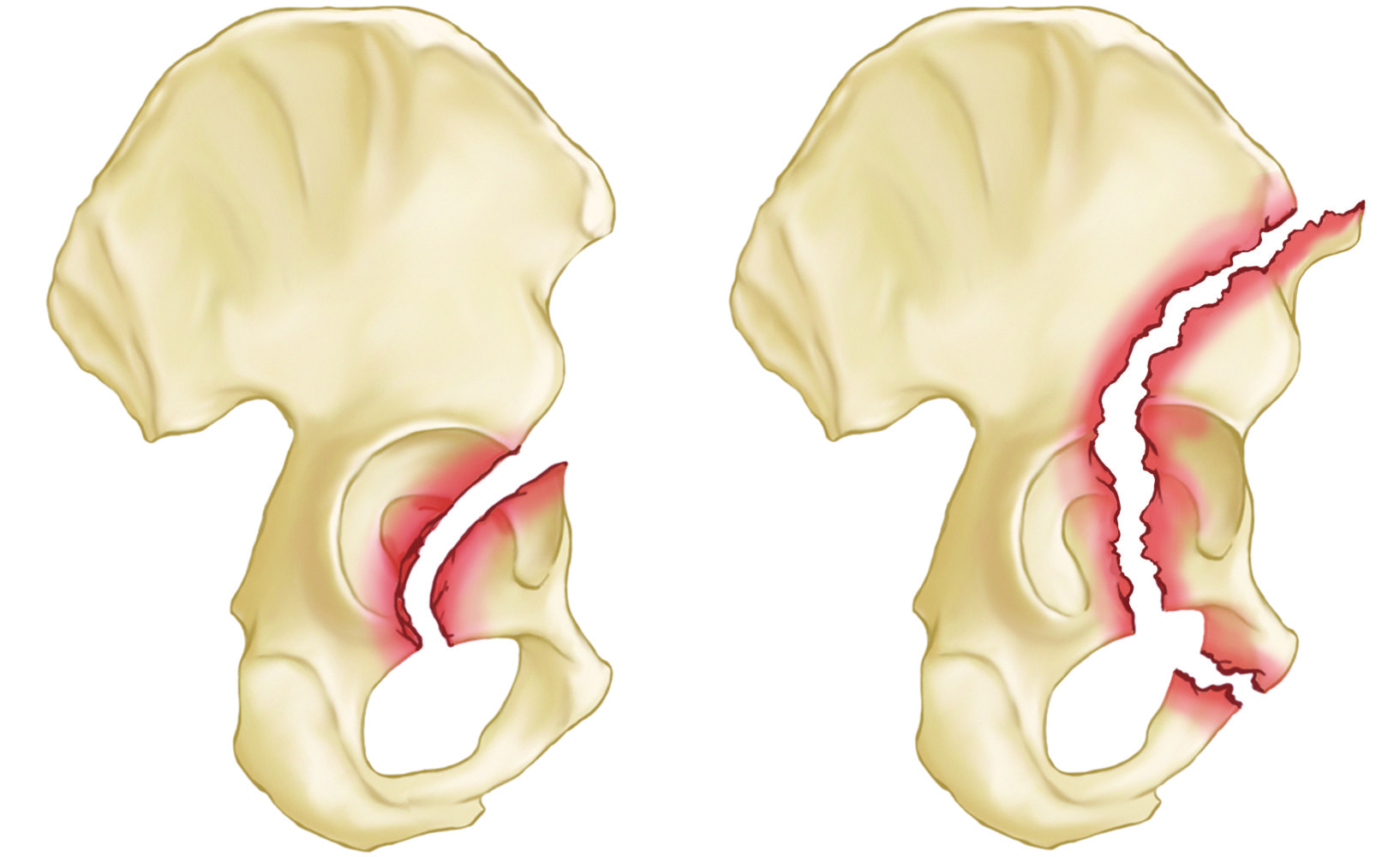 Acetabular Fractures Orthoinfo Aaos 6000