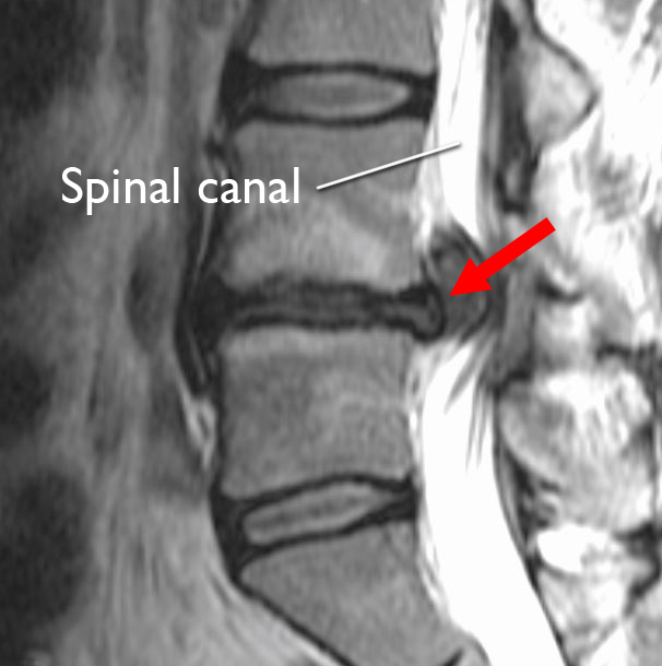 Lumbar Disc Herniation - What You Need to Know