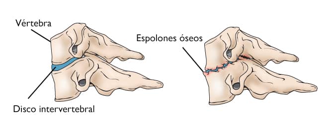 Radiculopatía cervical (nervio pinzado) (Cervical Radiculopathy (Pinched  Nerve)) - OrthoInfo - AAOS