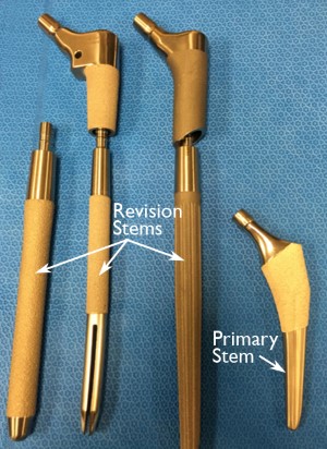 Revision Total Hip Replacement - OrthoInfo - AAOS