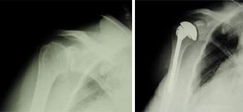 Before and after total shoulder replacement