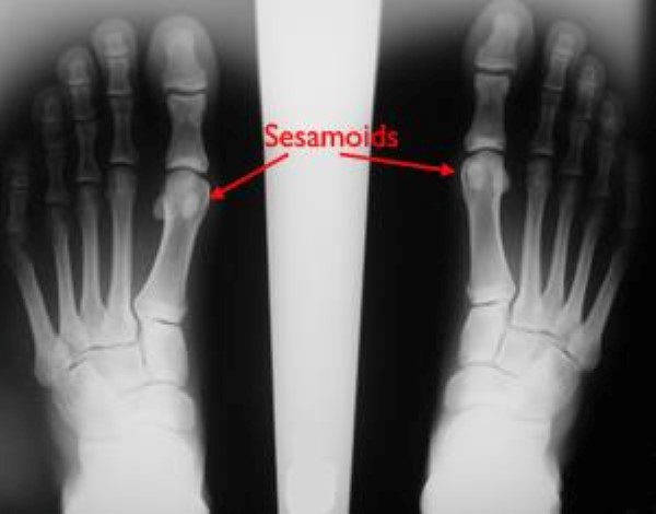 Turf Toe - OrthoInfo - AAOS