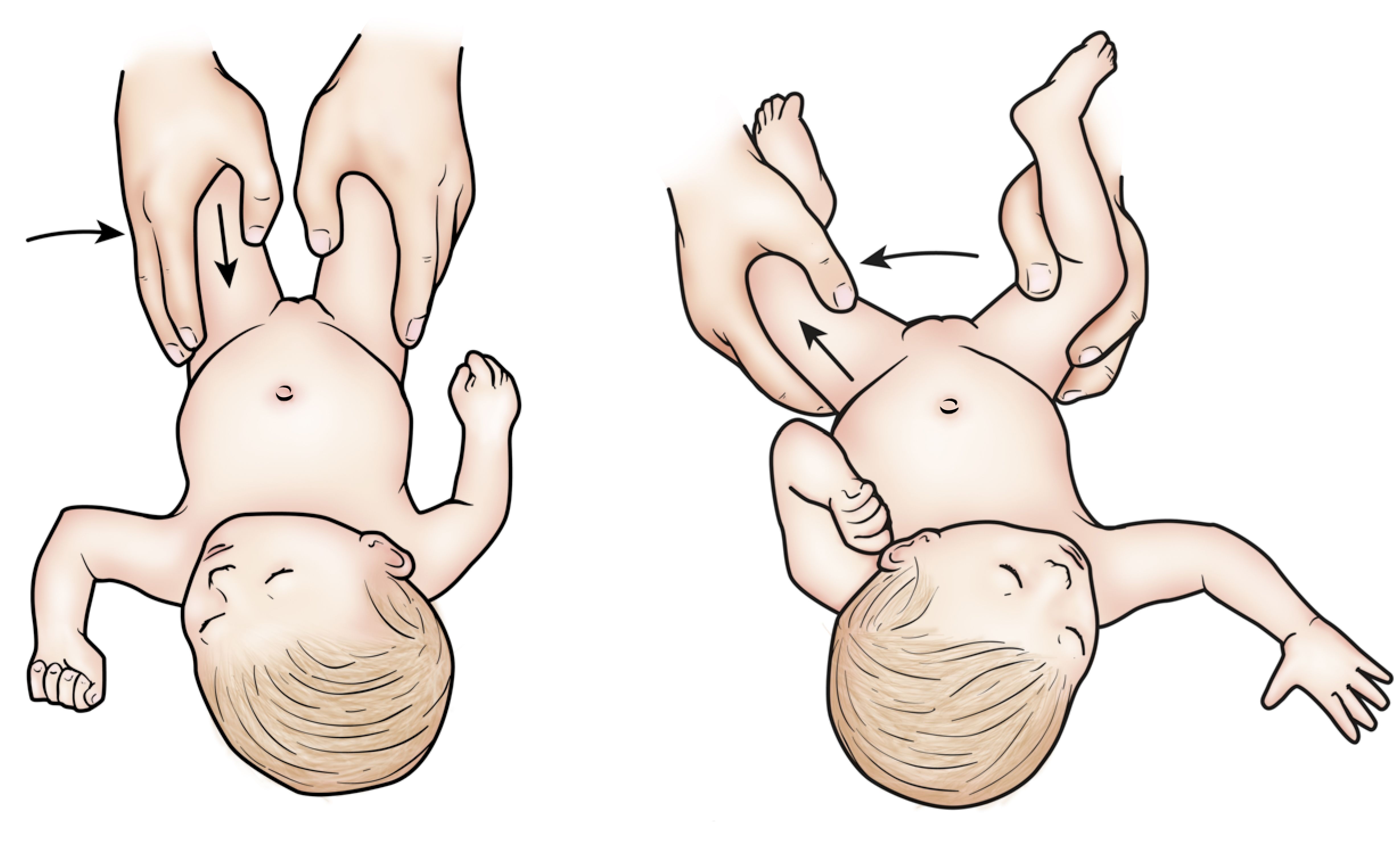 Hip dysplasia clearance treatment in infants