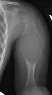 Radiograph of ABC in Humerus