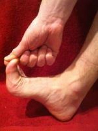 Big Toe Sprain - Foot - Conditions - Musculoskeletal - What We Treat 