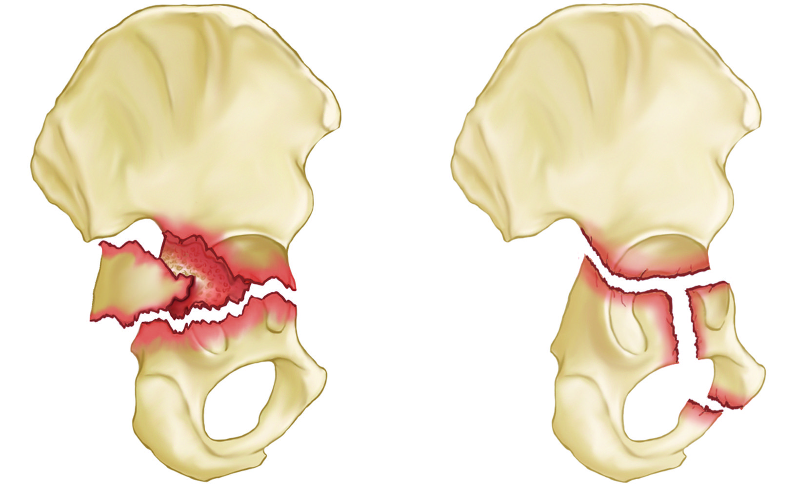 Transverse and T-shaped acetabulum fractures