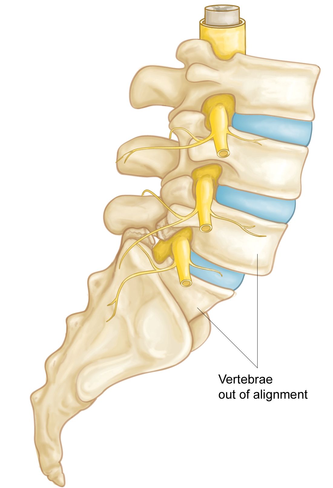 Lumbar Spinal Stenosis - OrthoInfo - AAOS