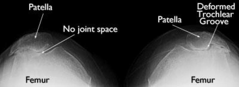 Patellofemoral Arthritis Orthoinfo Aaos