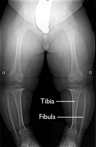 X-ray of bowed legs