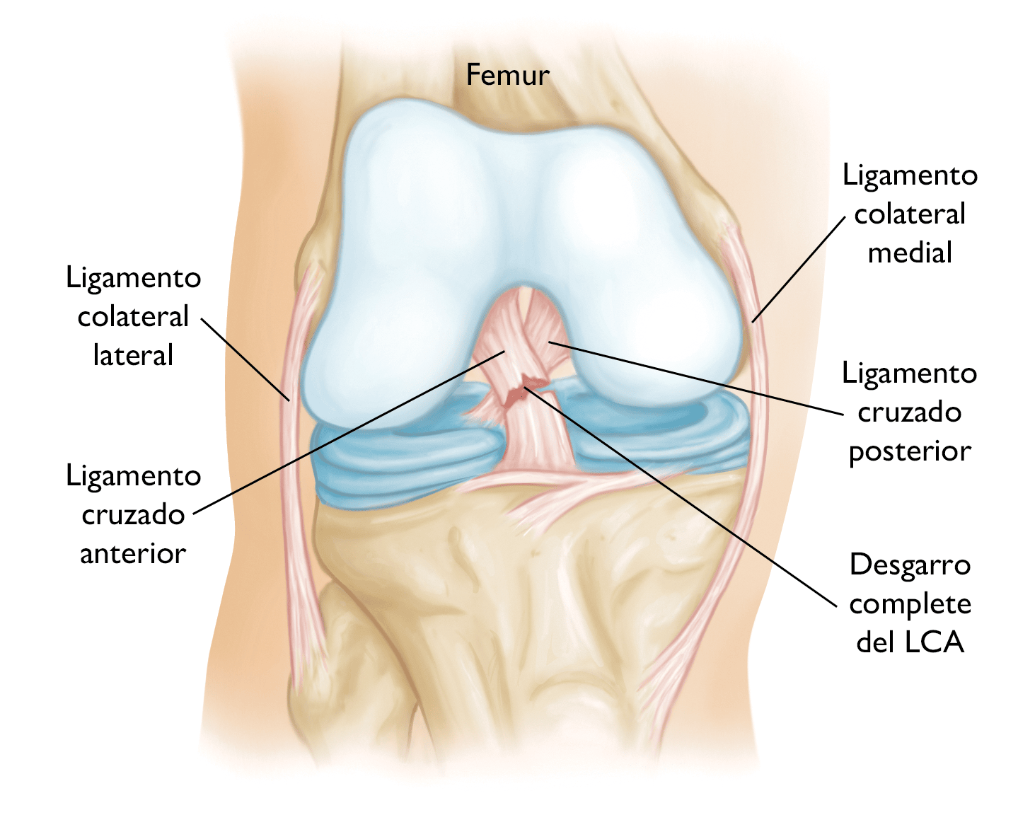 Qué son los meniscos de la rodilla y cuáles son sus lesiones