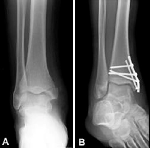 Ankle Fracture, Broken Ankle