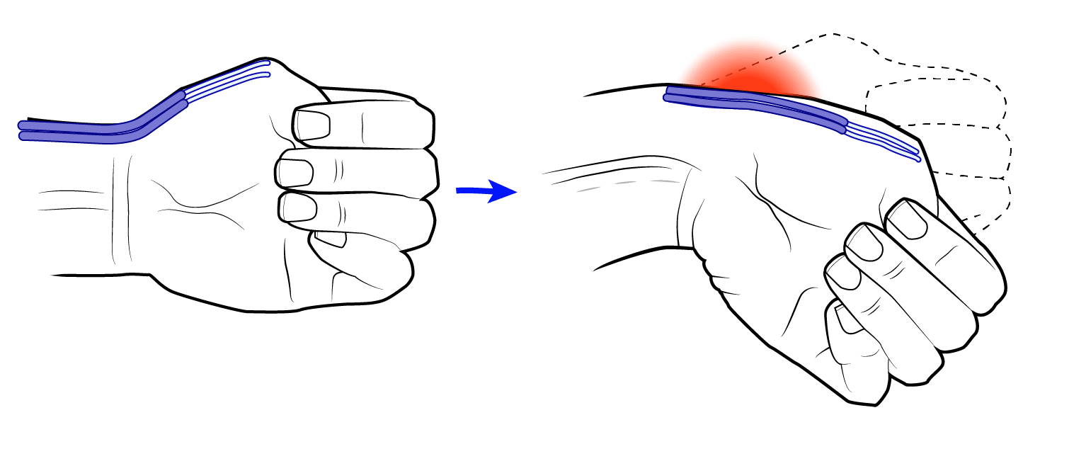 Tendinitis de quervain - Ortoeco