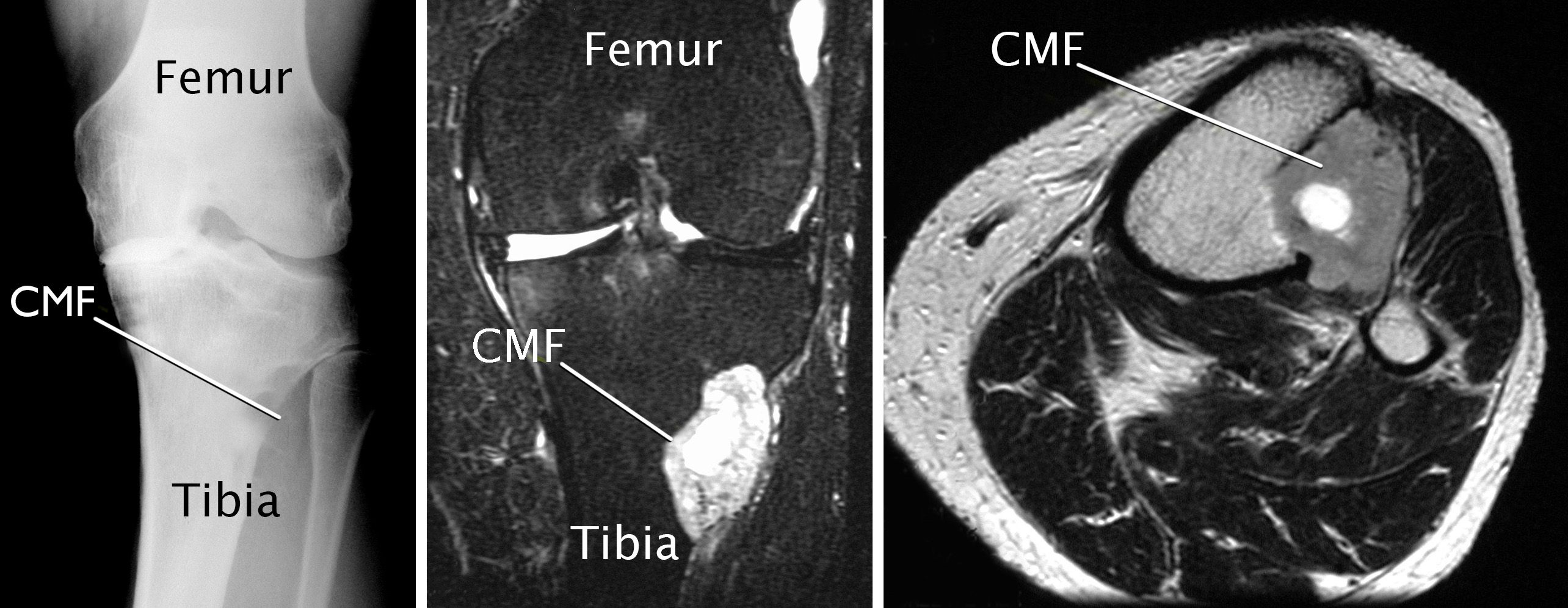 exploraciones por imágenes de fibroma condromixoide