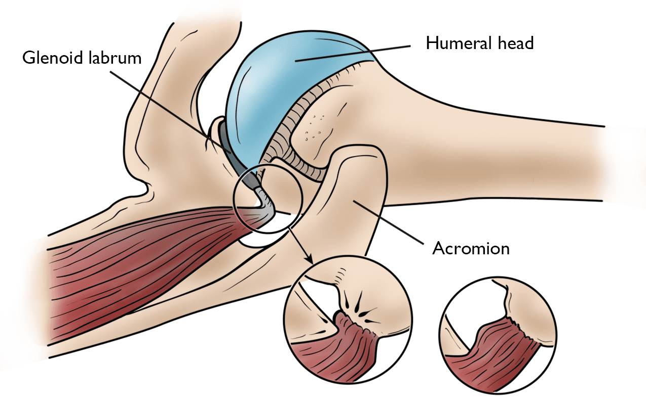 Internal store impingement shoulder