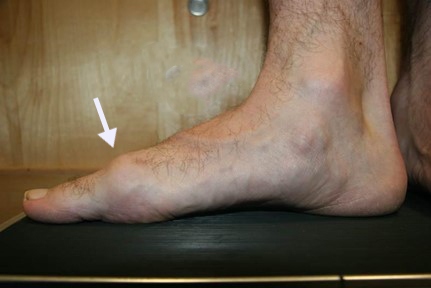 Bony growth on top clearance of foot