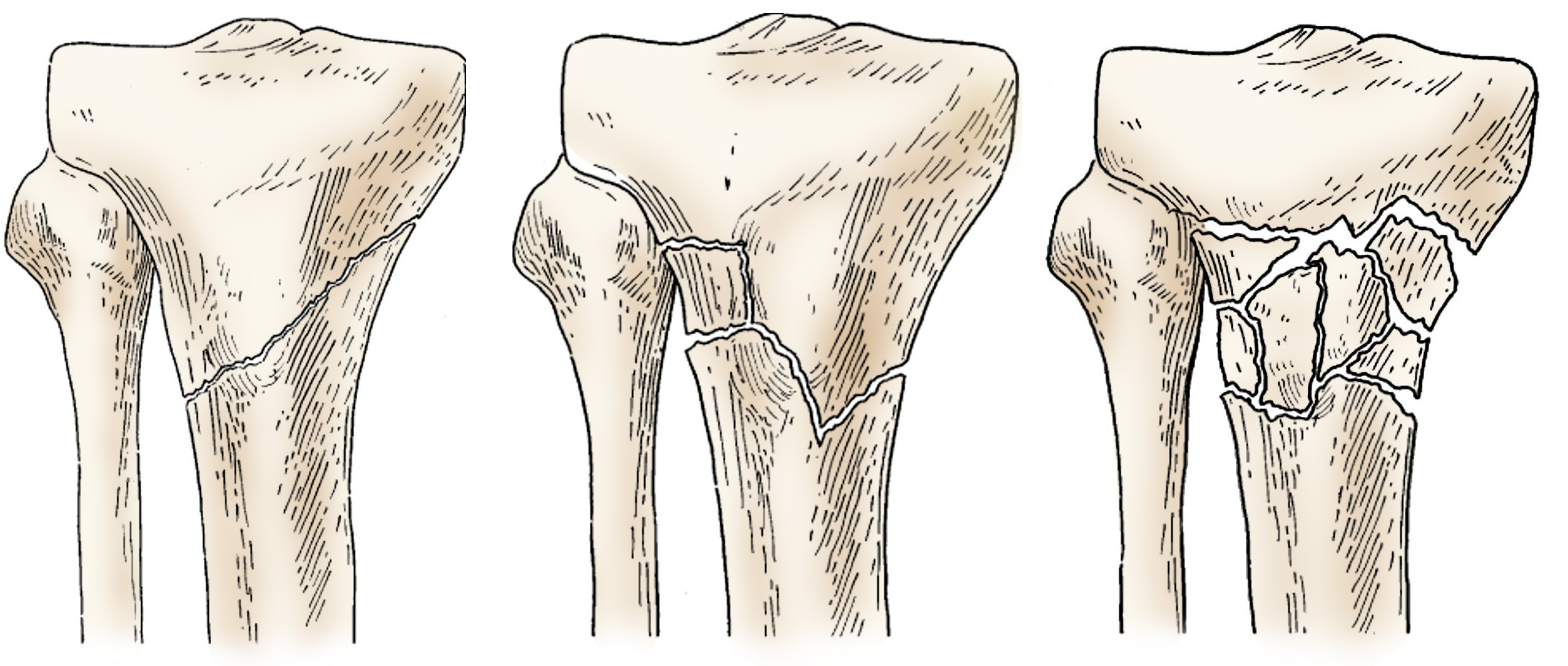 fractures-of-the-proximal-tibia-shinbone-orthoinfo-aaos