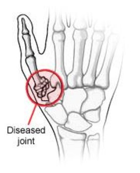 Illustration of arthritis at the base of the thum