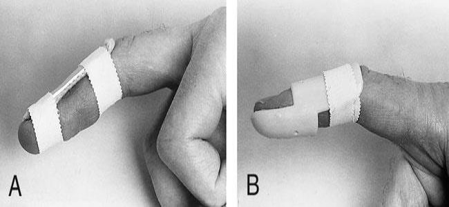 Splinting for mallet finger