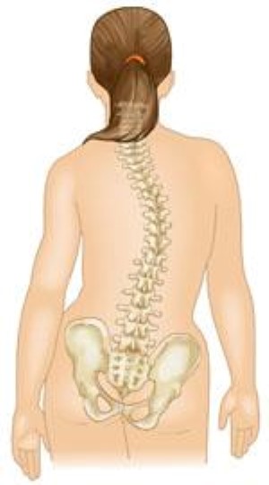 scoliosis curves