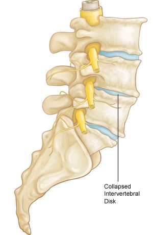Illustration of a collapsed intervertebral disk