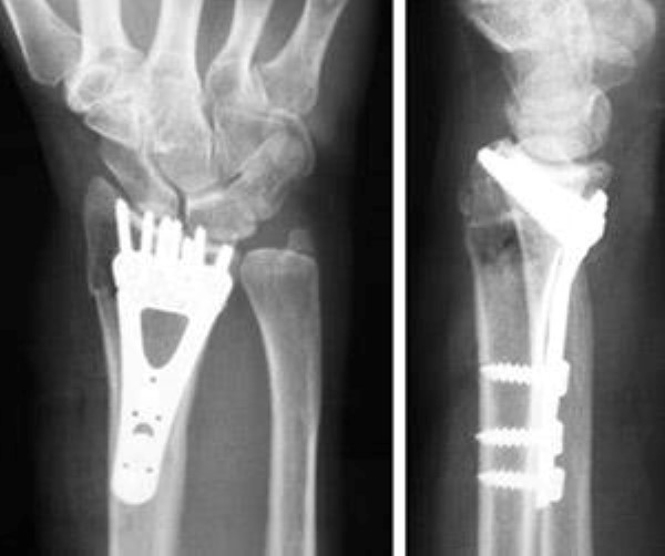 Distal Radius Fractures Broken Wrist OrthoInfo AAOS