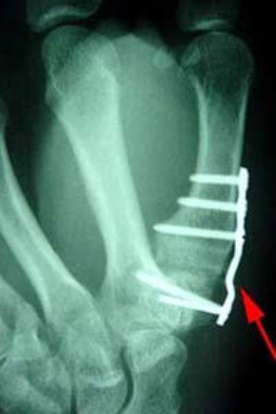 X-ray of joint fusion at base of thumb