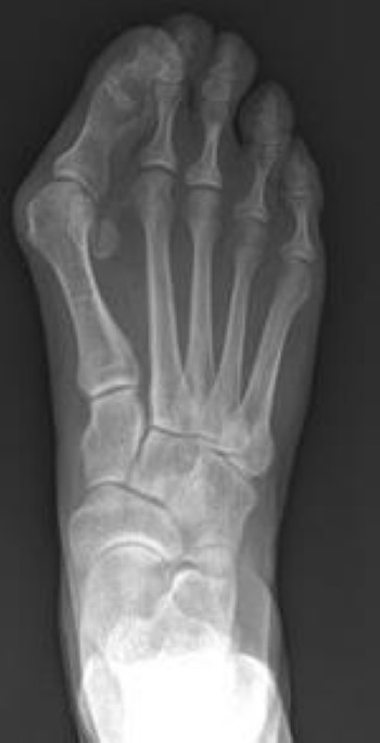 X-ray of bunion