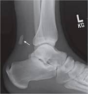 Calcaneal spur hot sale achilles tendon