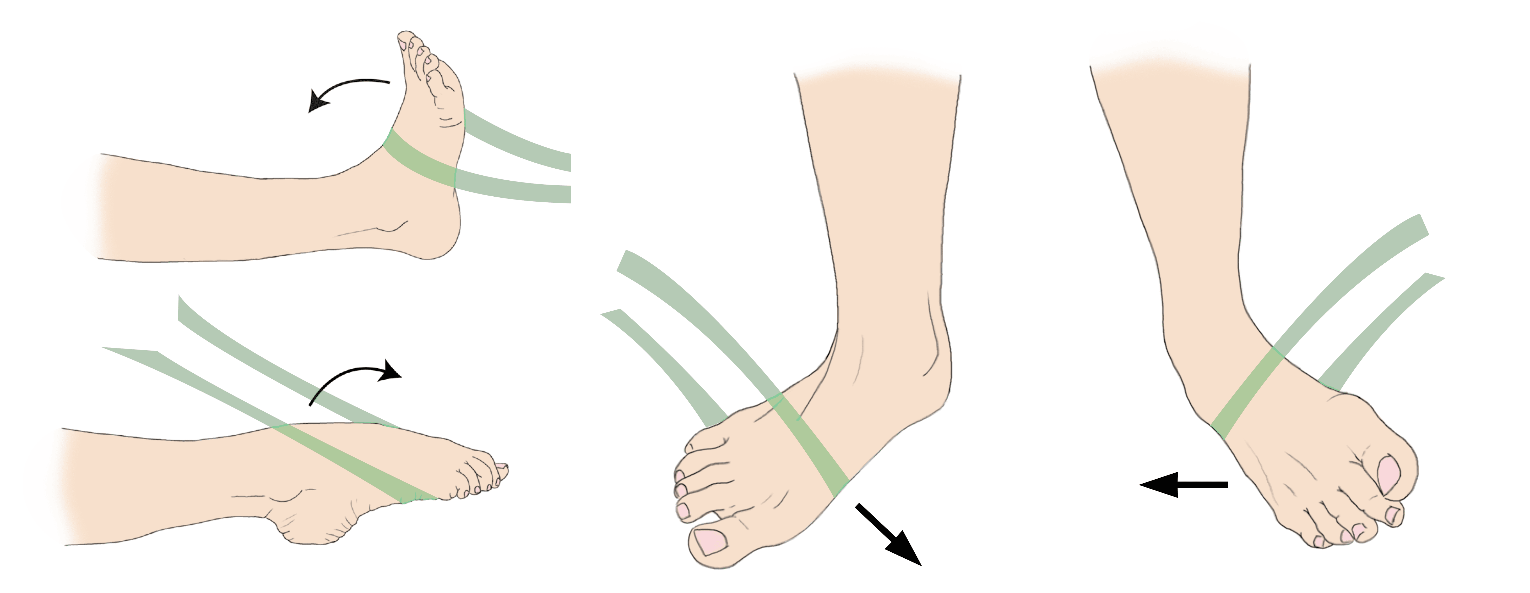 grade 1 ankle sprain swelling