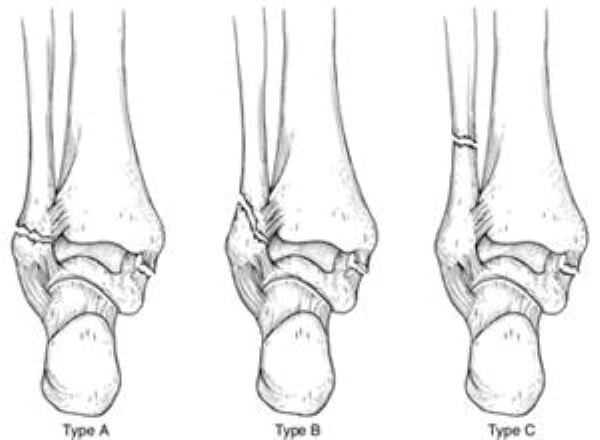lateral malleolus fractures