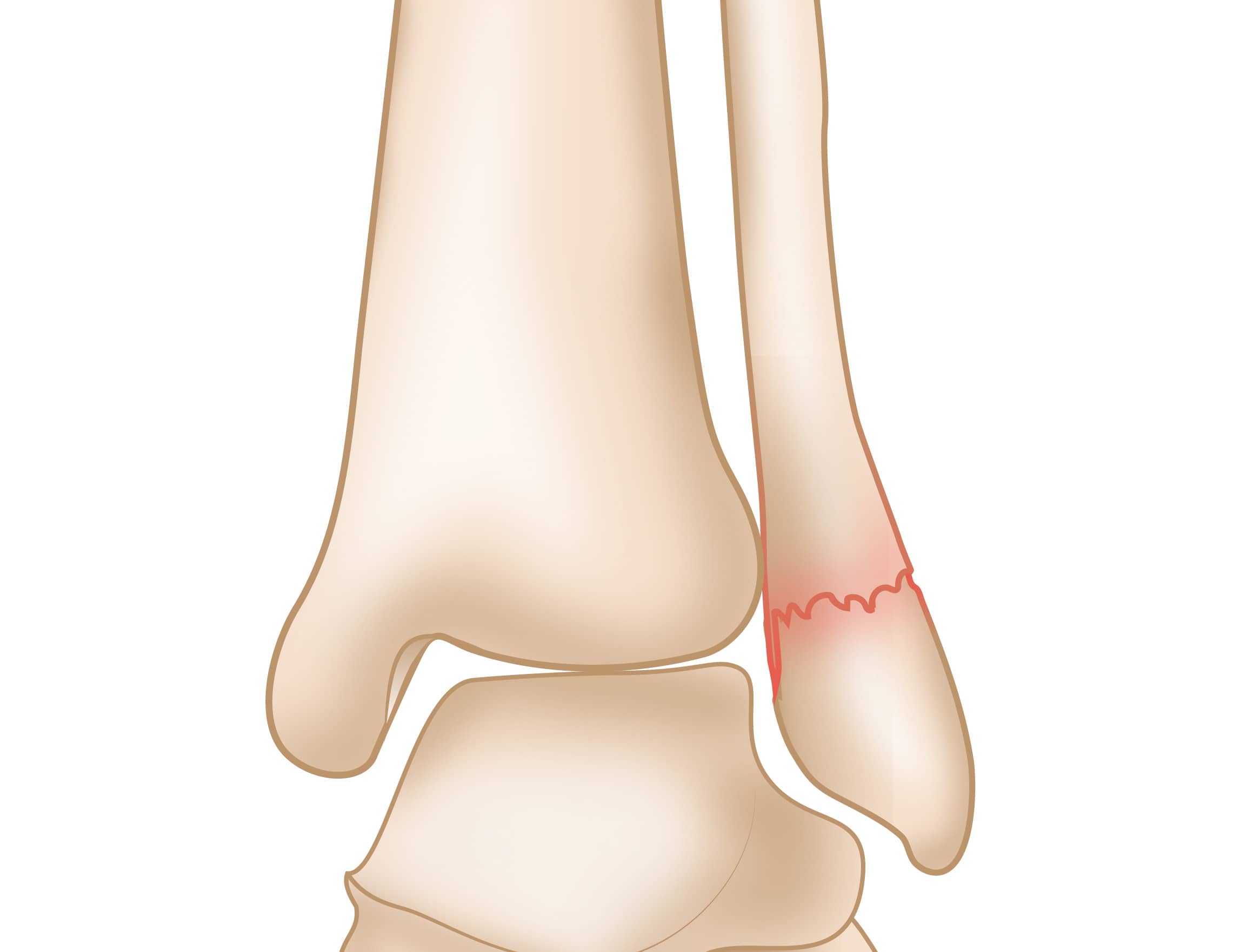 Ankle Fractures (Broken Ankle) - OrthoInfo - AAOS