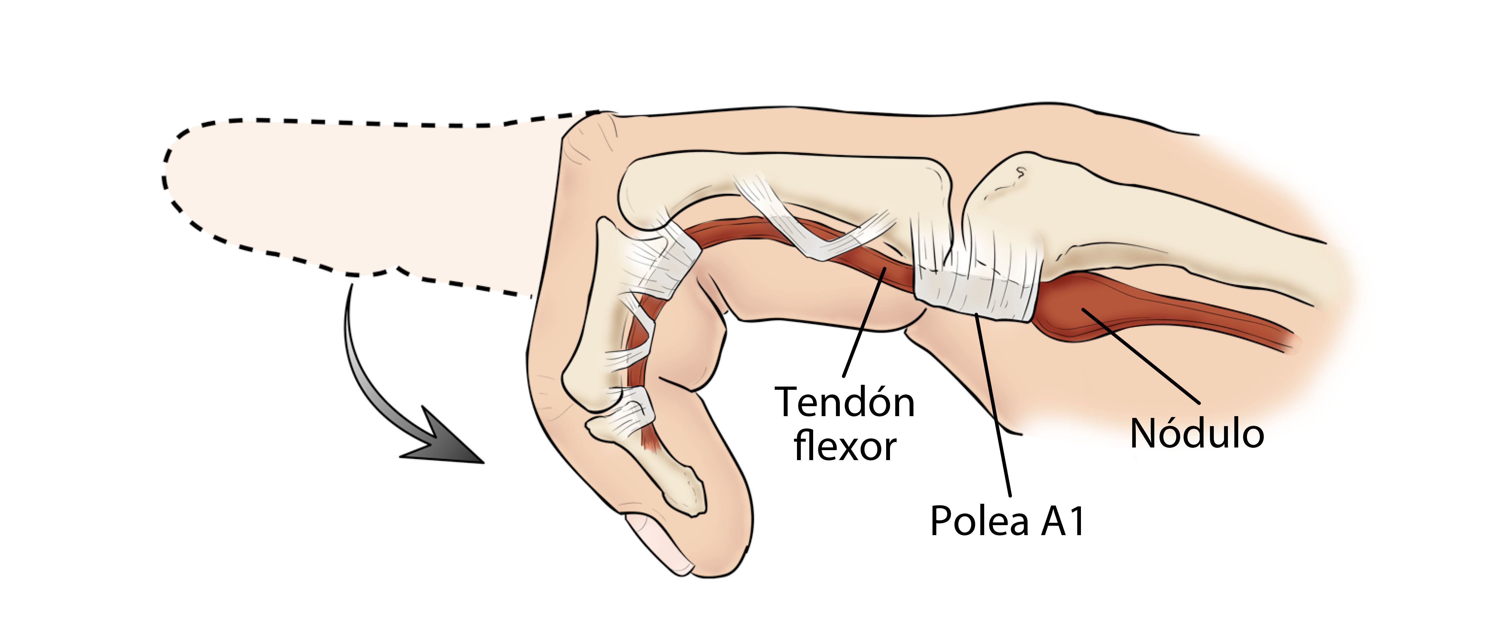 damnificados Aplastar personalidad Dedo en gatillo (Trigger Finger) - OrthoInfo - AAOS