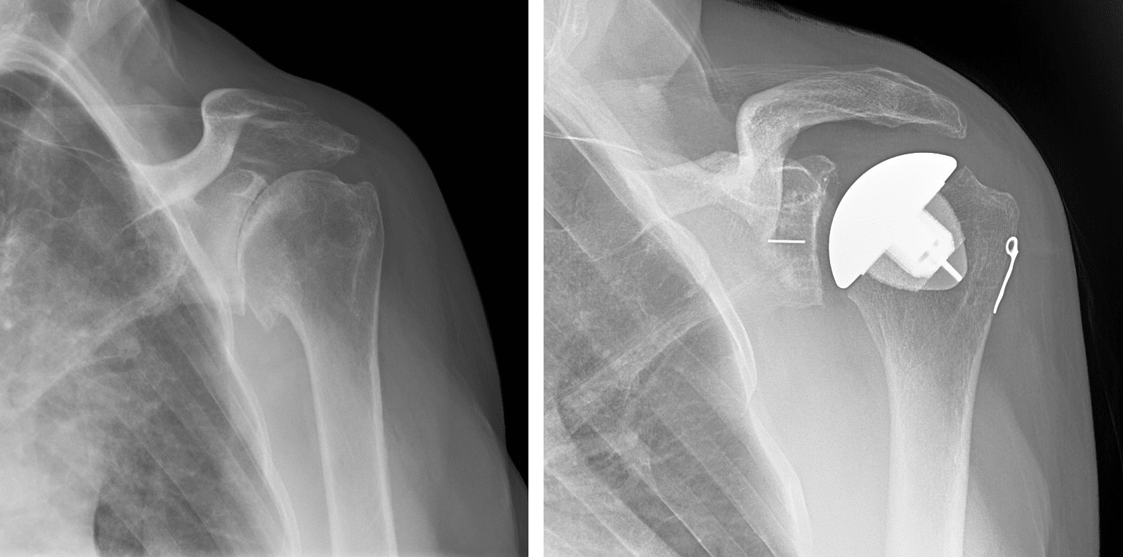 Shoulder Joint Replacement OrthoInfo AAOS