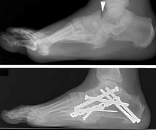 (Charcot) - OrthoInfo - AAOS