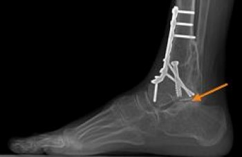 Arthritis in subtalar joint