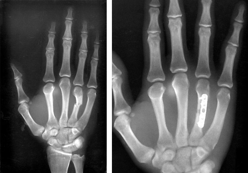 Hand Fractures Orthoinfo Aaos