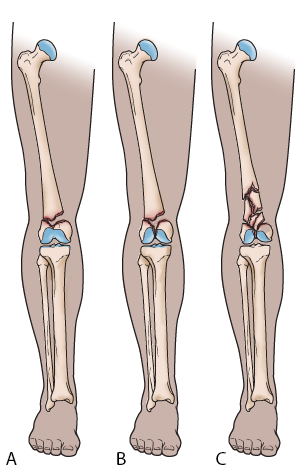 Different types of distal femur fractures