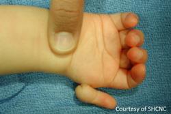 thumb hypoplasia