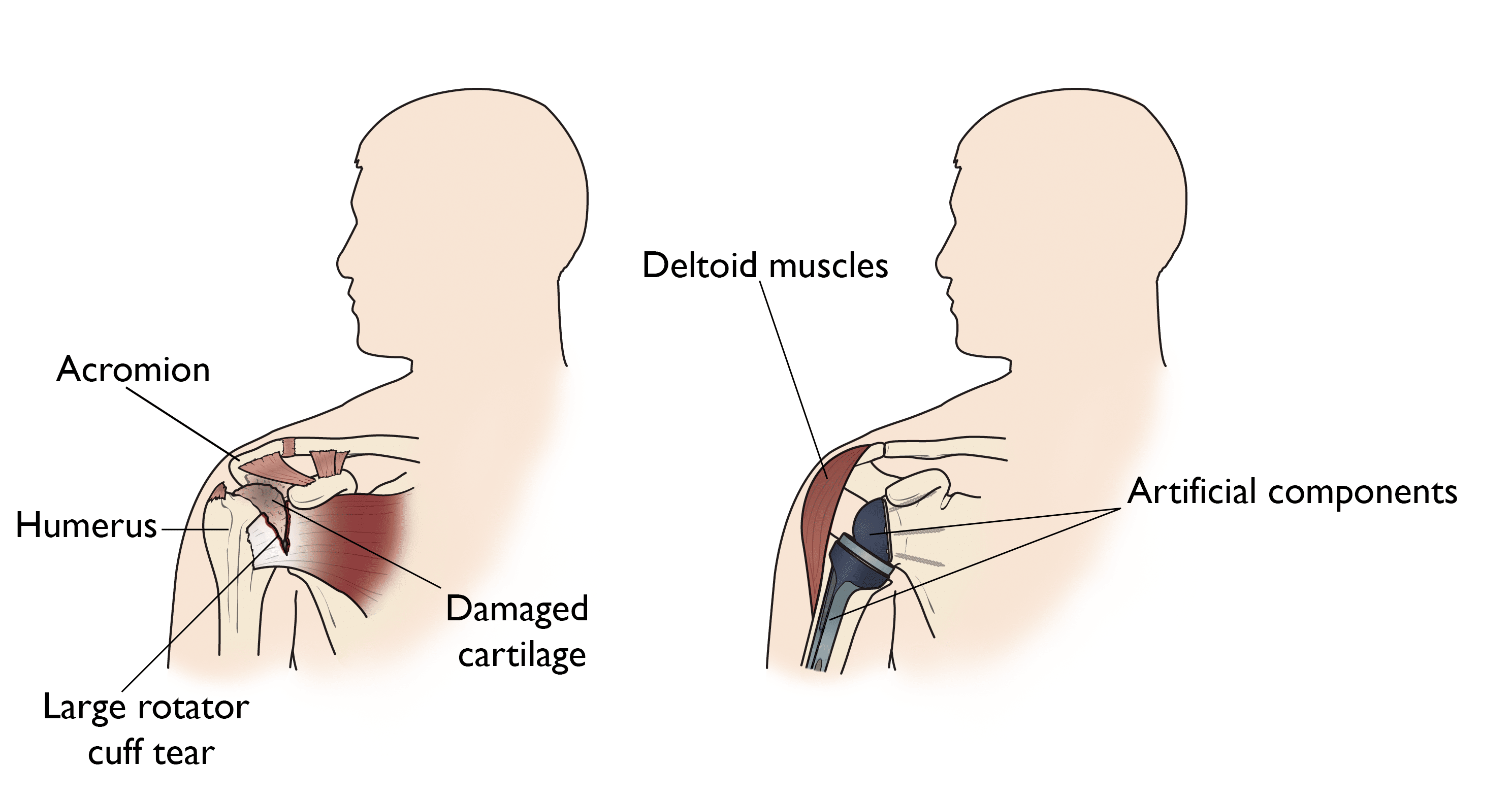 Rotator cuff arthropathy and reverse total shoulder replacement