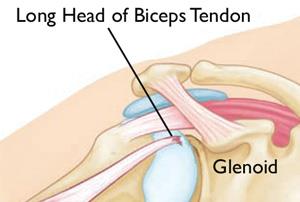 ripped bicep tendon