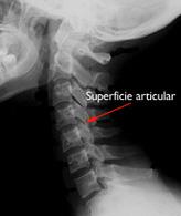 Osteoartritis de rodilla (Knee Osteoarthritis) - OrthoInfo - AAOS